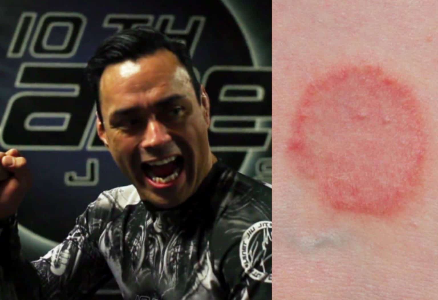 How To Avoid Ringworm From Wrestling And BJJ? – Fluentbjj.com